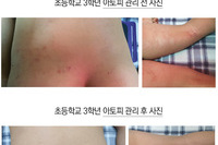 초등학교 3학년 아이 아토피가 3개월 만에 좋아졌습니다.